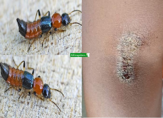 La mouche Nairobi et son effet sur la peau