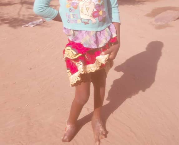 Feature image Salimatou Camara, brûlée des deux pieds par sa maman